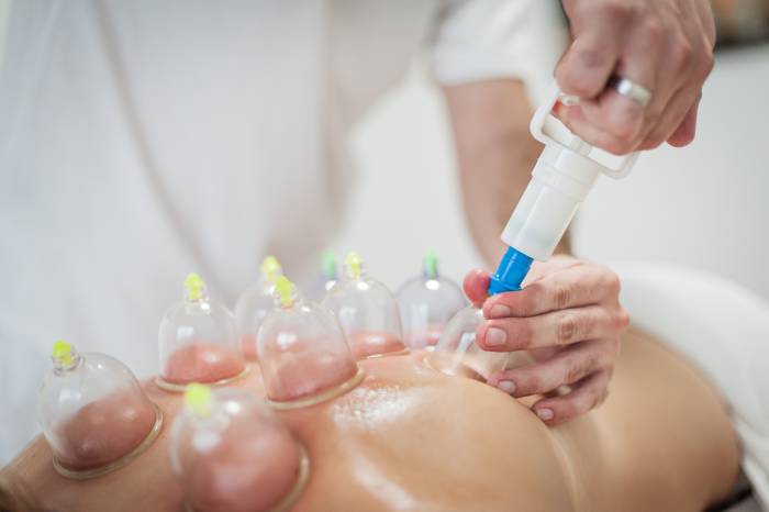 Dry Cupping
